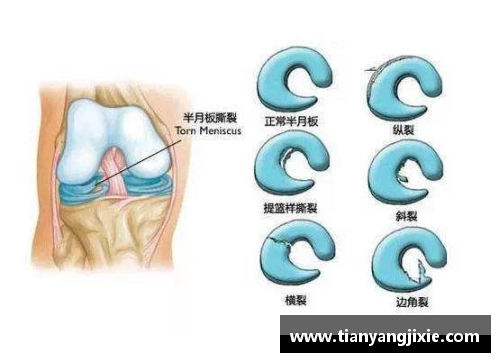 半月板受伤的体育明星及其复出之路的传奇故事